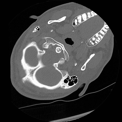 C1-C2 "subluxation" - normal cervical anatomy at maximum head rotation (Radiopaedia 42483-45607 Axial non-contrast 59).jpg