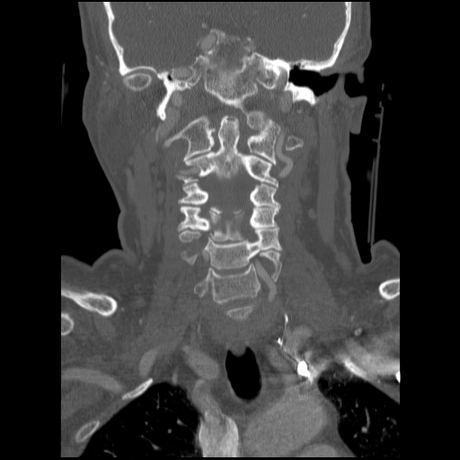 File:C1 anterior arch (plough) fracture - type 1 (Radiopaedia 76181-87720 Coronal bone window 54).jpg