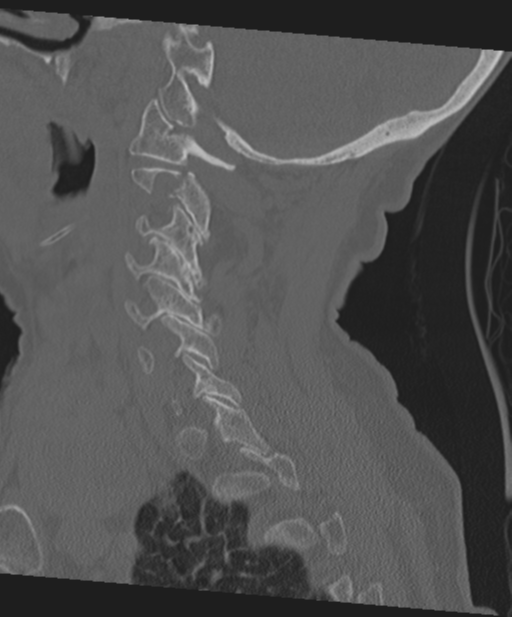 C2 fracture with vertebral artery dissection (Radiopaedia 37378-39199 Sagittal bone window 52).png