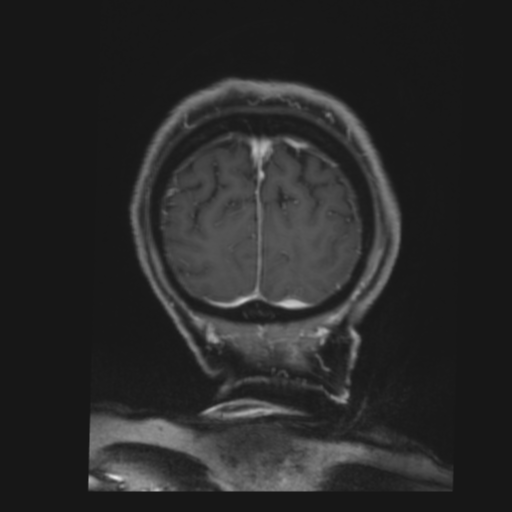 CNS lymphoma with steroid response (Radiopaedia 37980-39921 Coronal T1 C+ 46).png