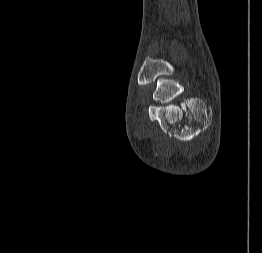 File:Calcaneal fracture - Sanders type 4 (Radiopaedia 90179-107370 Coronal bone window 75).jpg