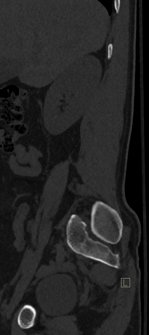 Calcaneal fractures with associated L2 burst fracture (Radiopaedia 71671-82493 Sagittal bone window 79).jpg