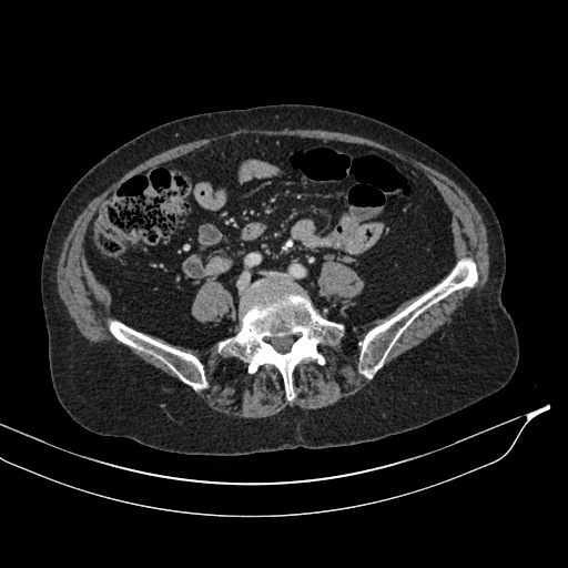 Calcified adrenal glands and Spigelian hernia (Radiopaedia 49741-54988 A 146).jpg