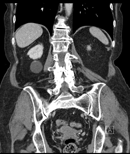 Calcified adrenal glands and Spigelian hernia (Radiopaedia 49741-54988 B 83).jpg