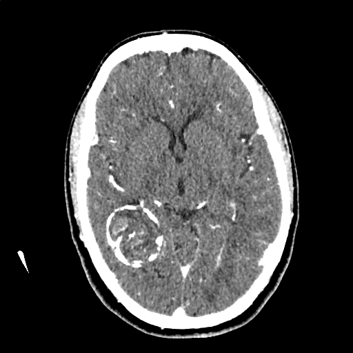 File:Calcified cerebral hydatid cyst (Radiopaedia 65603-74717 Axial with contrast 34).jpg