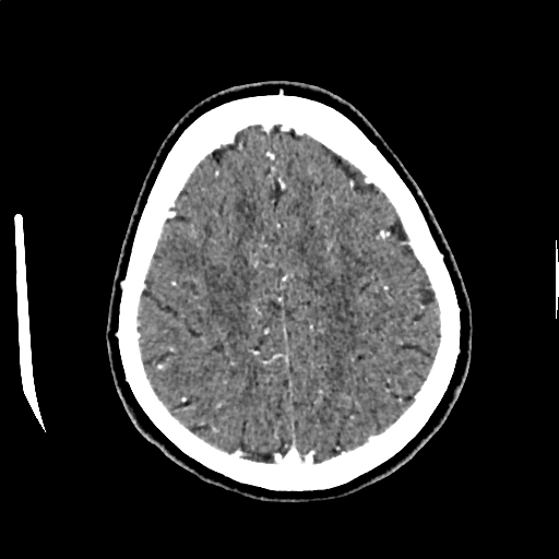 Calcified cerebral hydatid cyst (Radiopaedia 65603-74717 Axial with contrast 62).jpg