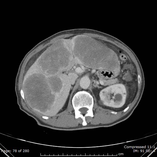 Calcified liver metastases (Radiopaedia 44699-48470 B 28).jpg