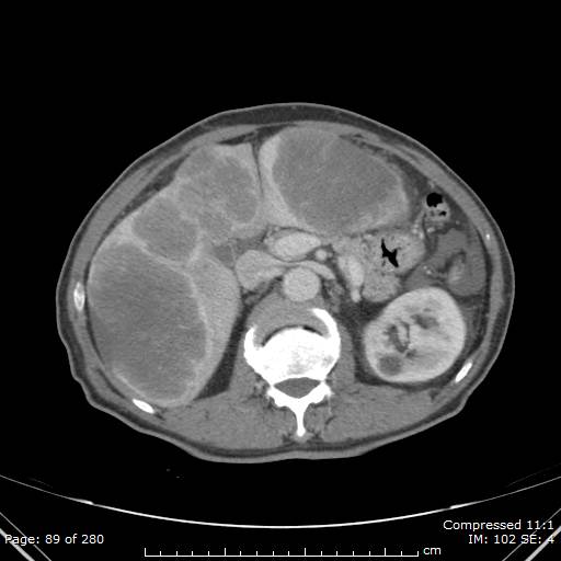 Calcified liver metastases (Radiopaedia 44699-48470 B 32).jpg