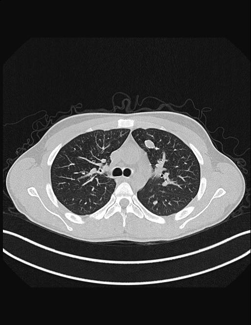 Calcifying pulmonary metastases (Radiopaedia 33359-34396 Axial lung window 22).jpg