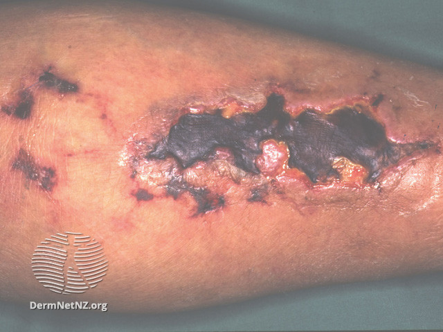 File:Calciphylaxis can lead to- (DermNet NZ systemic-calciphylaxis3).jpg