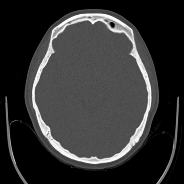 Calvarial osteoma (Radiopaedia 36520-38079 Axial bone window 46).jpg