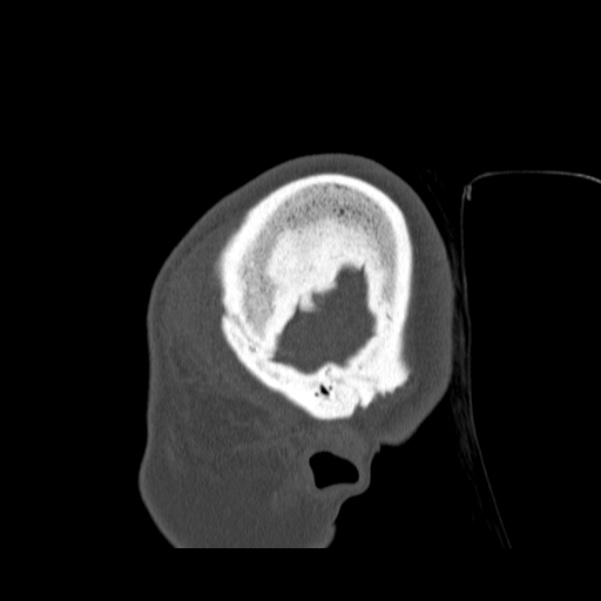 Calvarial osteoma (Radiopaedia 36520-38079 Sagittal bone window 100).jpg