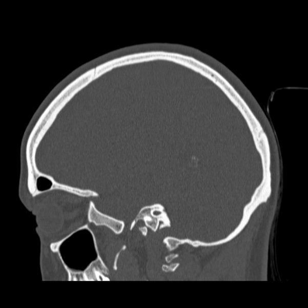 Calvarial osteoma (Radiopaedia 36520-38079 Sagittal bone window 72).jpg