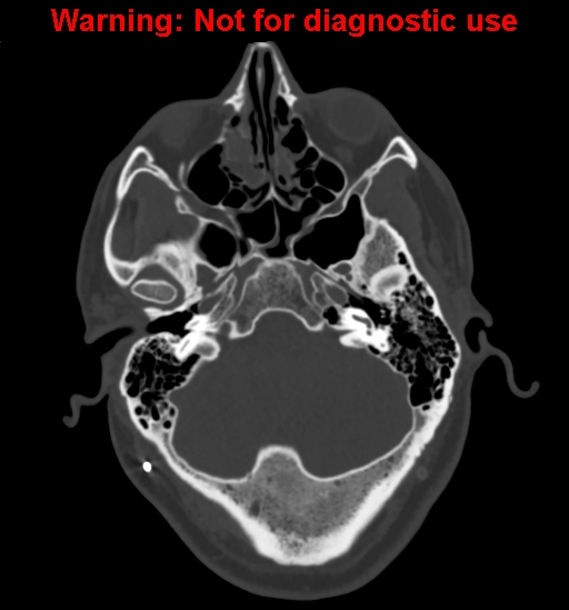 File:Calvarial thickening from chronic shunting (Radiopaedia 60079-67637 Axial bone window 34).jpg