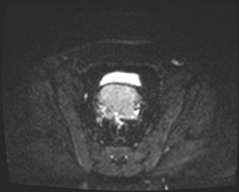 Cancer cervix - stage IIb (Radiopaedia 75411-86615 Axial DWI 18).jpg