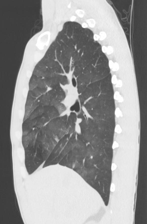 Cannabis-induced diffuse alveolar hemorrhage (Radiopaedia 89834-106946 Sagittal lung window 51).jpg