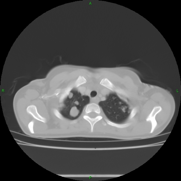 File:Cannon ball metastases - synovial sarcoma (Radiopaedia 26135-26271 Axial lung window 6).jpg