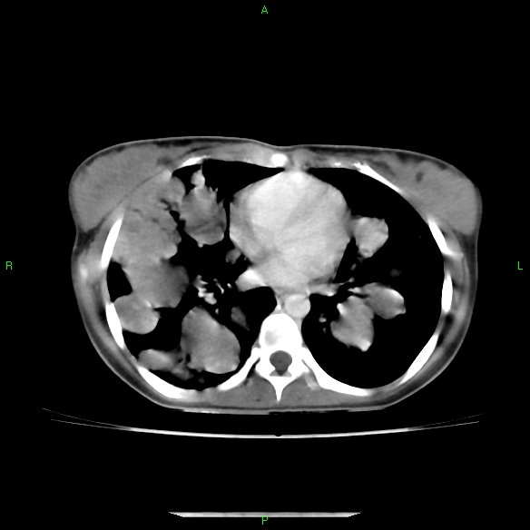 File:Cannon ball metastases - synovial sarcoma (Radiopaedia 26135-26271 C 21).jpg