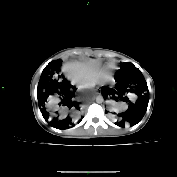File:Cannon ball metastases - synovial sarcoma (Radiopaedia 26135-26271 C 28).jpg