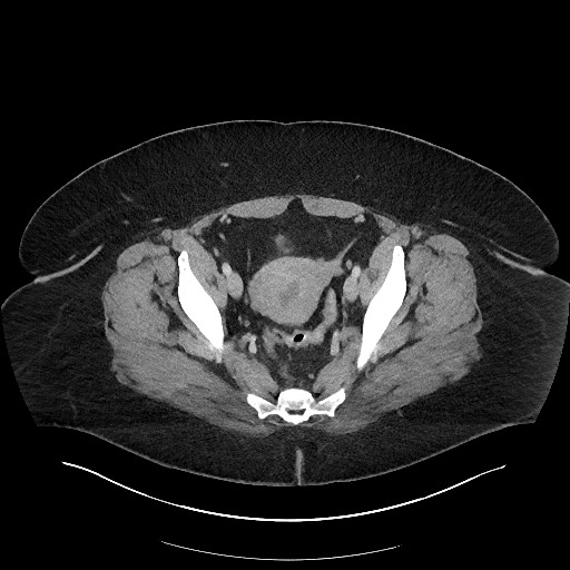Carcinoid tumor - terminal ileum (Radiopaedia 60931-68739 A 113).jpg