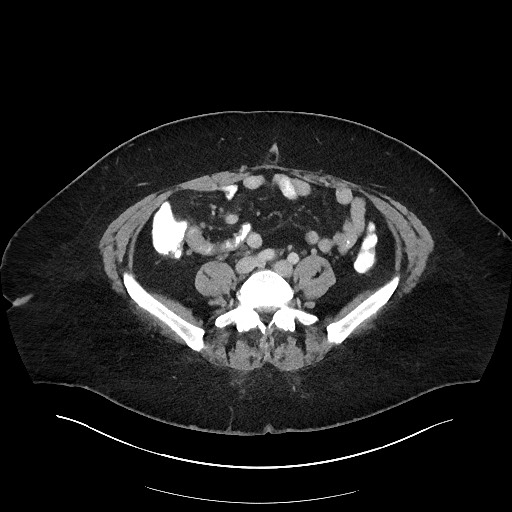 File:Carcinoid tumor - terminal ileum (Radiopaedia 60931-68739 A 87).jpg