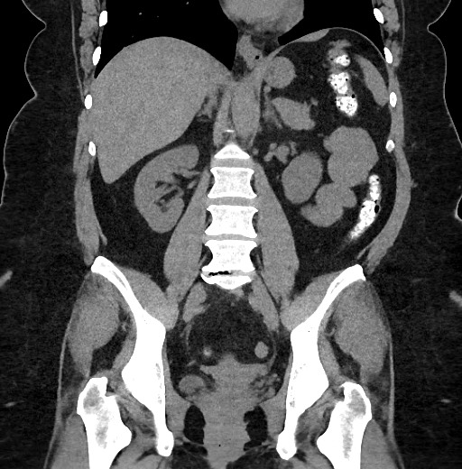 Carcinoid tumor - terminal ileum (Radiopaedia 60931-68740 Coronal non-contrast 63).jpg