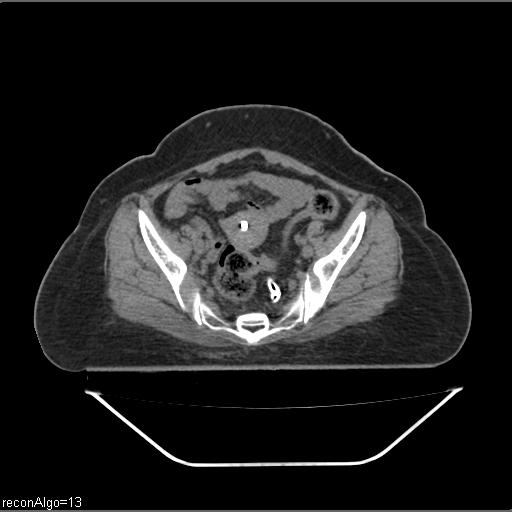 File:Carcinoma cervix- brachytherapy applicator (Radiopaedia 33135-34173 Axial non-contrast 18).jpg