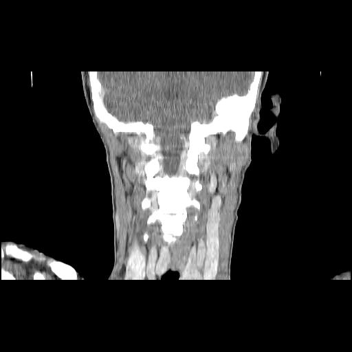 Carcinoma of the maxillary antrum (Radiopaedia 53805-59888 Coronal C+ delayed 114).jpg