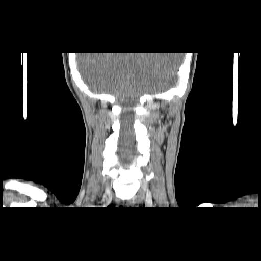 Carcinoma of the maxillary antrum (Radiopaedia 53805-59888 Coronal C+ delayed 125).jpg