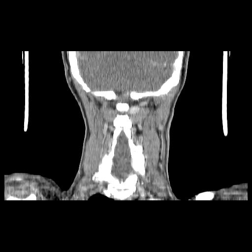 File:Carcinoma of the maxillary antrum (Radiopaedia 53805-59888 Coronal C+ delayed 132).jpg