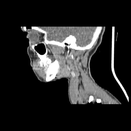 Carcinoma of the maxillary antrum (Radiopaedia 53805-59888 Sagittal C+ delayed 134).jpg