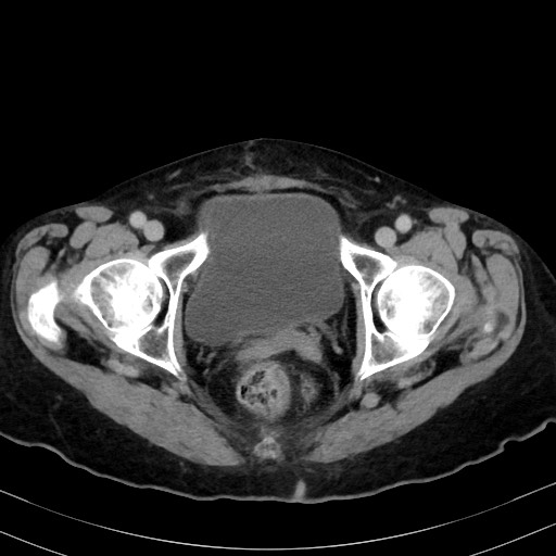 Carcinosarcoma (Radiopaedia 70401-80503 A 64).jpg