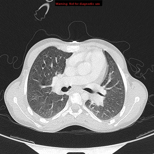 File:Cardiac bronchus (Radiopaedia 14059-13899 A 15).jpg