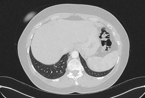 Cardiac sarcoidosis (Radiopaedia 74548-85534 Axial lung window 80).jpg