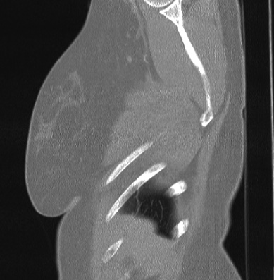 File:Cardiac sarcoidosis (Radiopaedia 74548-85534 Sagittal lung window 87).jpg