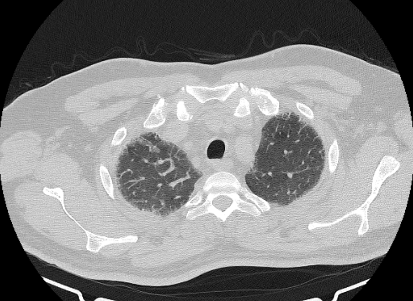 Cardiogenic pulmonary edema (Radiopaedia 68180-77678 Axial lung window 12).jpg
