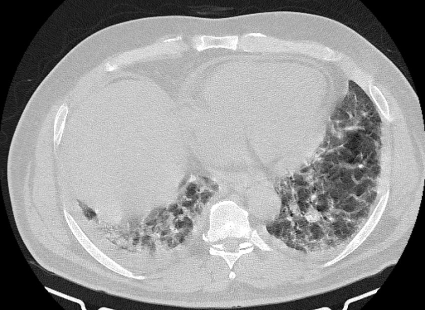 Cardiogenic pulmonary edema (Radiopaedia 68180-77678 Axial lung window 74).jpg