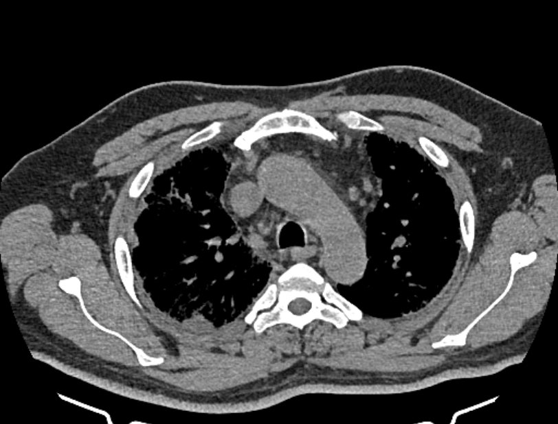 Cardiogenic pulmonary edema (Radiopaedia 68180-77678 Axial non-contrast 12).jpg