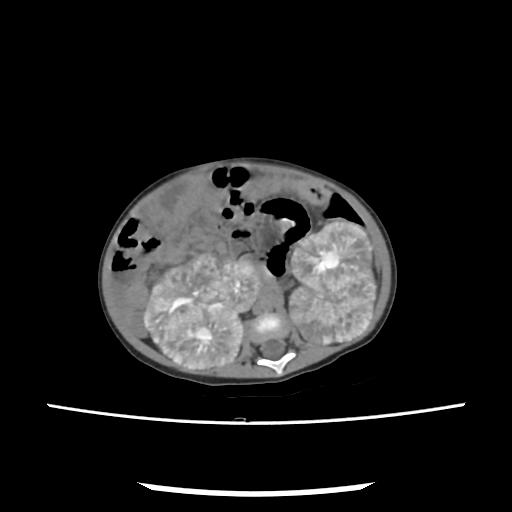 File:Caroli disease with autosomal recessive polycystic kidney disease (ARPKD) (Radiopaedia 89651-106703 E 122).jpg