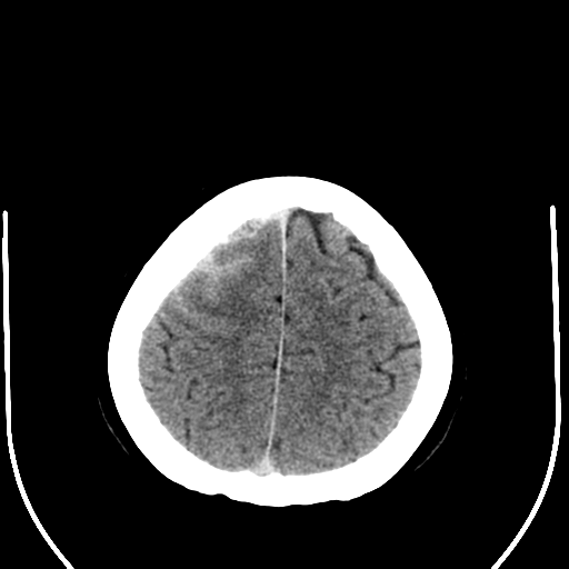 File:Carotico ophthalmic aneurysm (Radiopaedia 42916-46147 Axial non-contrast 22).png