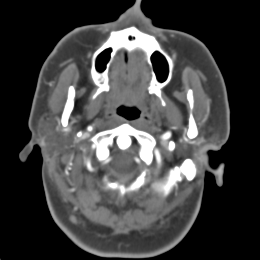 Carotico ophthalmic aneurysm (Radiopaedia 42916-46148 A 50).png