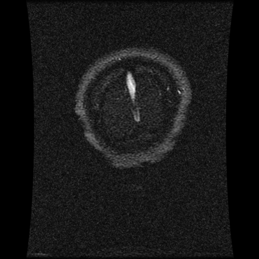 Carotid arterial dissection with acute cerebral infarction (Radiopaedia 26636-26784 MRV 33).jpg