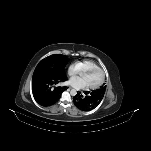 File:Carotid body tumor (Radiopaedia 21021-20948 B 46).jpg