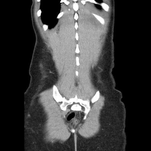 Castleman disease with fibrous pseudotumor in the abdomen (Radiopaedia 77296-89373 B 83).jpg