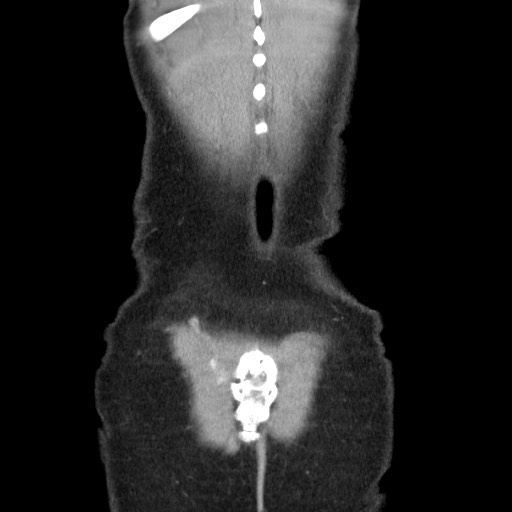 File:Castleman disease with fibrous pseudotumor in the abdomen (Radiopaedia 77296-89373 B 88).jpg