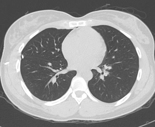 File:Catamenial pneumothorax (Radiopaedia 54382-60600 Axial 26).png