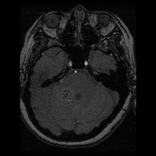 Cavernoma, DVA and right ICA aneurysm (Radiopaedia 33890-35072 E 73).png