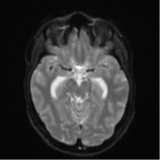 File:Cavernoma with bleed - midbrain (Radiopaedia 54546-60774 Axial DWI 10).png