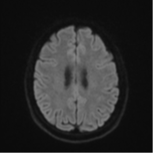 File:Cavernoma with bleed - midbrain (Radiopaedia 54546-60774 Axial DWI 46).png