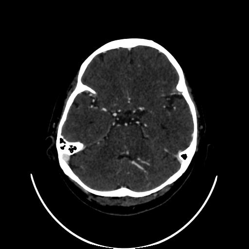 Cavernoma with developmental venous anomaly (Radiopaedia 22470-22506 C 48).jpg